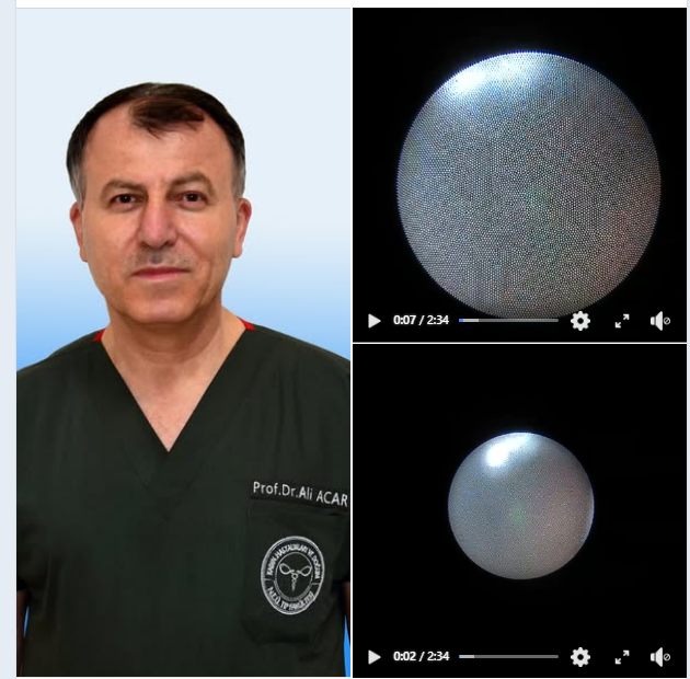 18 weeks and 6 days dichorionic triamniotic triplet pregnancy